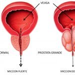 Aumento de tamanho da próstata é normal e tem tratamento, diz especialista