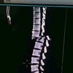 Homem quebra a coluna ao levantar peso em academia – Veja o vídeo