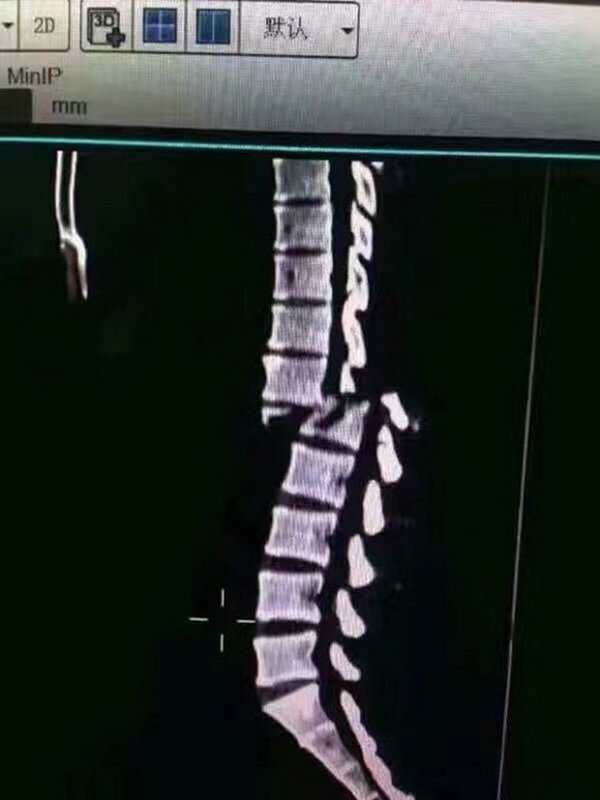 Homem quebra a coluna ao levantar peso em academia – Veja o vídeo